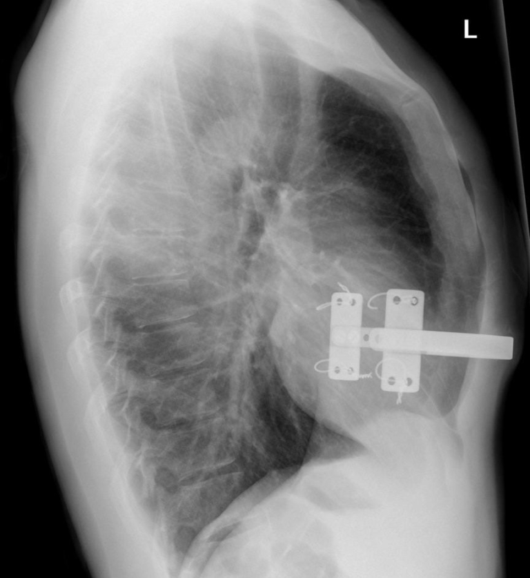 Surgeons unlock secret to treating pigeon chest Braceworks Custom