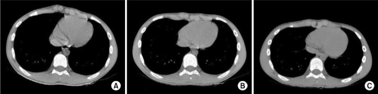 Fig. 3. These computed tomography scan images show three consecutive images taken from the same patient before, during, and after the recommended cycle of bracing treatment. A dramatic improvement in protrusion of chest wall is noted. (A) Before brace. (B) 2 months after brace. (C) 6 months after brace.