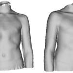 Evaluation of the treatment of pectus carinatum with compressive orthotic ...