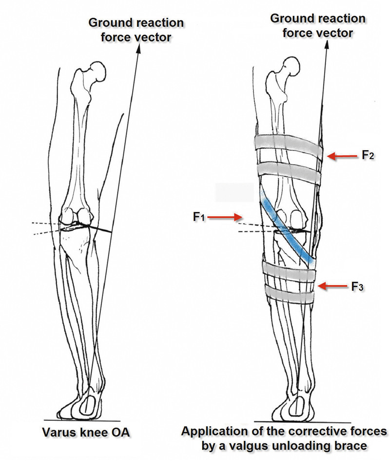 Figure 4. Three-point bending mechanism of a knee unloading brace.