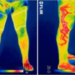 Infrared thermography, a support tool for orthopedic diagnosis