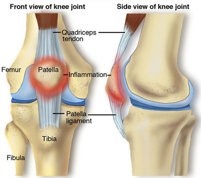 Patellofemoral pain syndrome is a broad term used to describe pain in the front of the knee and around the patella, or kneecap.