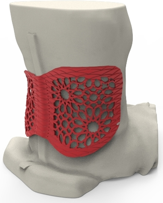 Using a 3D scan of Rožkova’s lower back, Baltic3D, a Stratasys Latvian reseller, designed and 3D printed a back brace customized specifically to her middle spine, overcoming the discomfort and limited movement found in conventional supports.