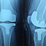 US study finds no way to predict risk of joint replacements