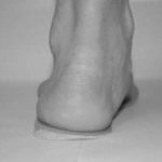 Foot and ankle issues may increase risk of knee OA