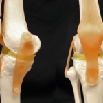 3D printable implants may ease damaged knees