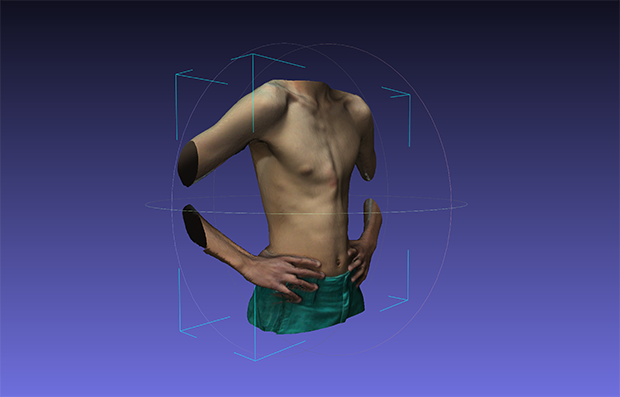 A) A picture of a pectus carinatum patient before brace treatment. (B)