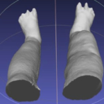 Portable 3D scanner assesses patients with elephantiasis