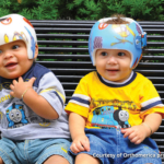 What is positional plagiocephaly?