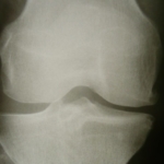 Knee pain lasting 1 year predicts faster cartilage loss, higher OA risk