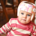 Heads-up on positional plagiocephaly and whether it can affect a child’s d...