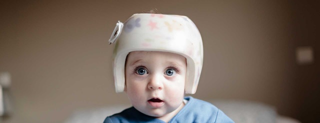 Baby head helmet 2024 reshape head cost