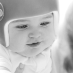 Earlier helmet therapy yields better results for infants with skull flatte...