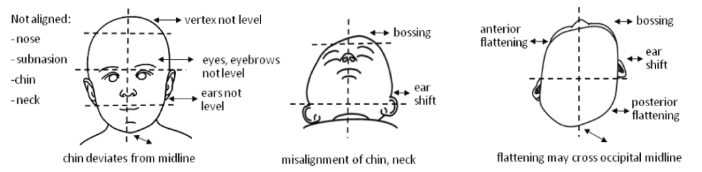 Nonsynostotic deformational plagiocephaly: Understand, screen, and ...