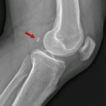 Mystery arthritis-linked knee bone three times more common than 100 years ...