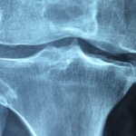 Osteoarthritis: Conservative therapy delays need for knee and hip joint re...