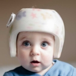 Helmet therapy for your baby