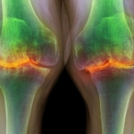 Lubricating arthritic knees with synthetic fluid may help tissue heal