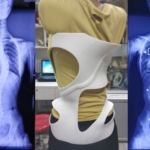 ‘Smart’ 3d-printed braces could improve scoliosis treatment