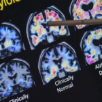 Alzheimer’s might not be primarily a brain disease. A new theory suggests ...