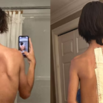 'They don't care about me, mom': Teen's scoliosis surgery delayed five tim...